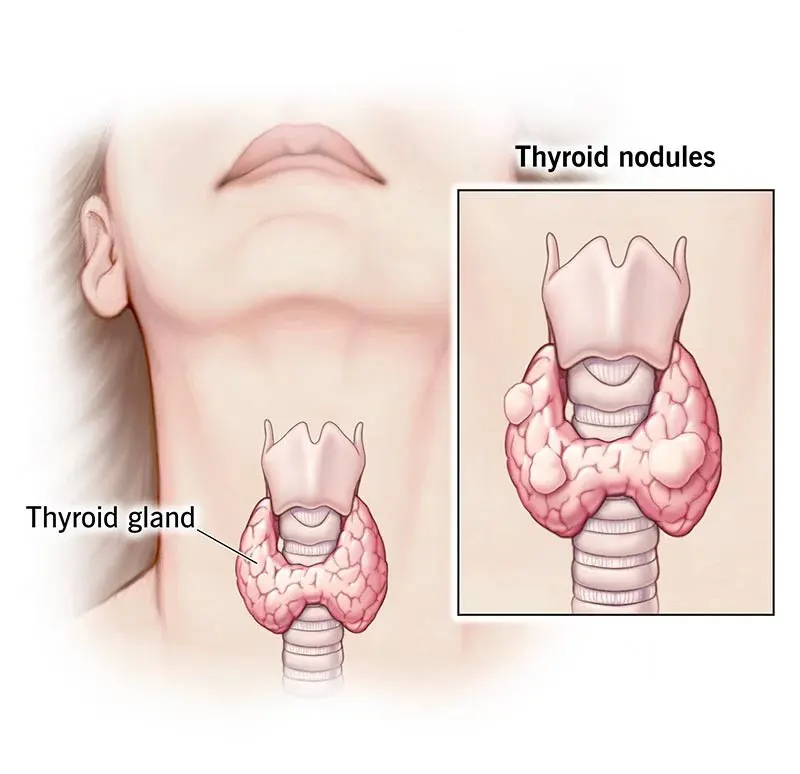 تیروئید چیست و چه علائمی دارد
